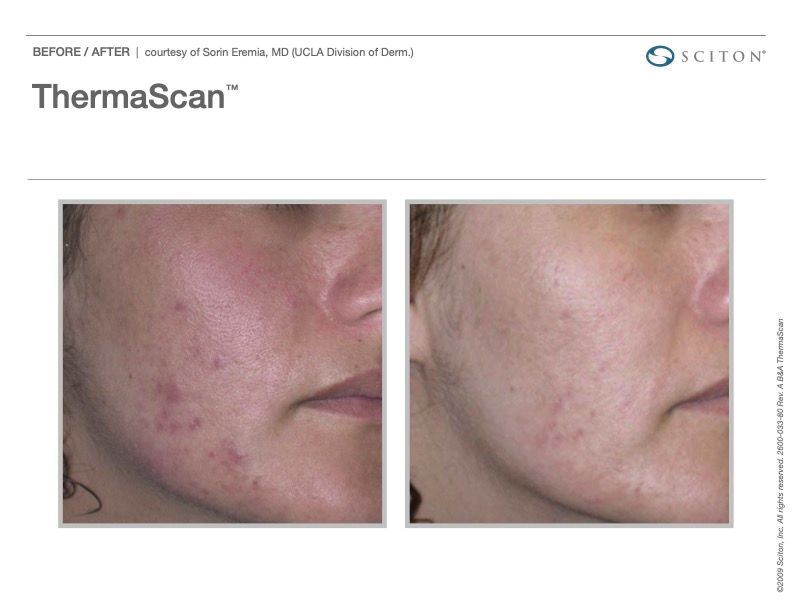 Sciton Joule Procedures  Before & After