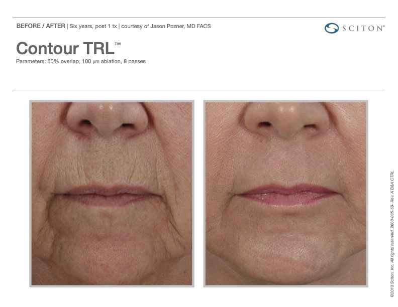 Sciton Joule Procedures  Before & After