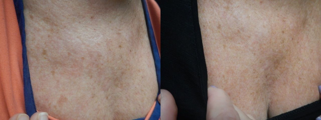 Regenerative Aesthetics Before & After