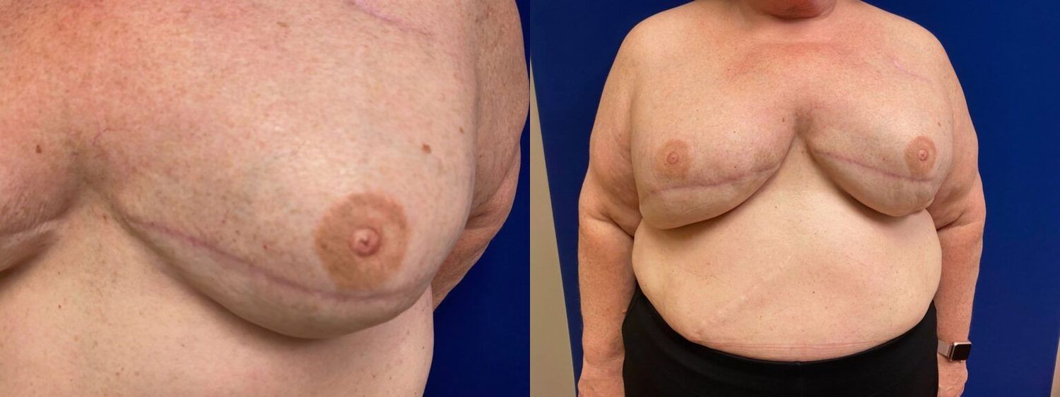 Nipple Tattooing Before & After