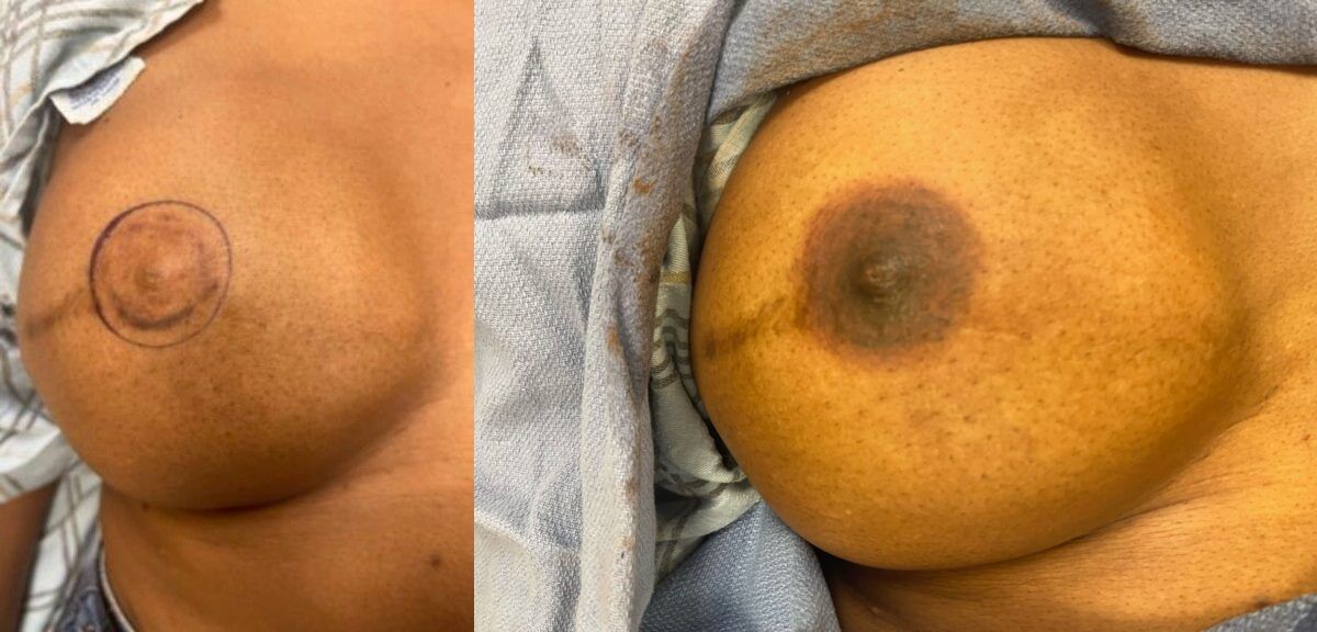 Nipple Tattooing Before & After