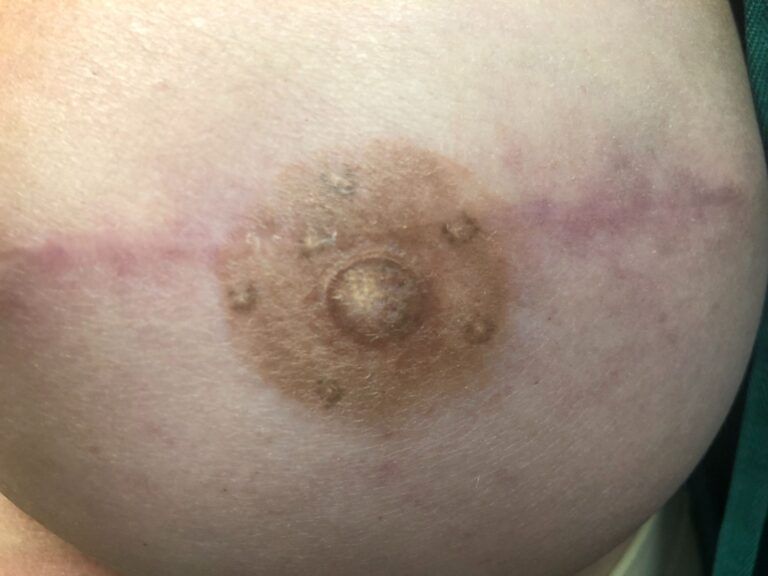 Nipple Tattooing Before & After