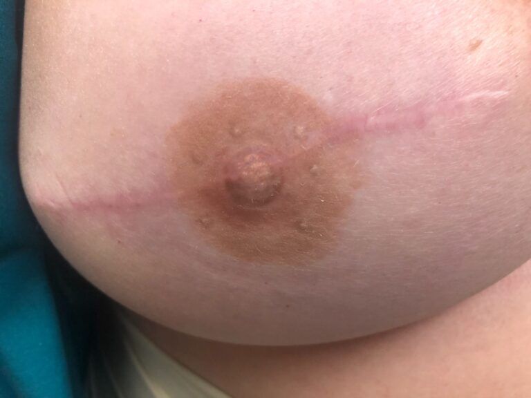 Nipple Tattooing Before & After