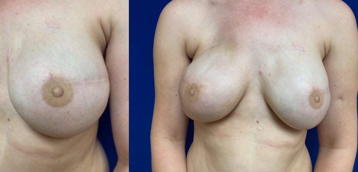 Nipple Tattooing Before & After