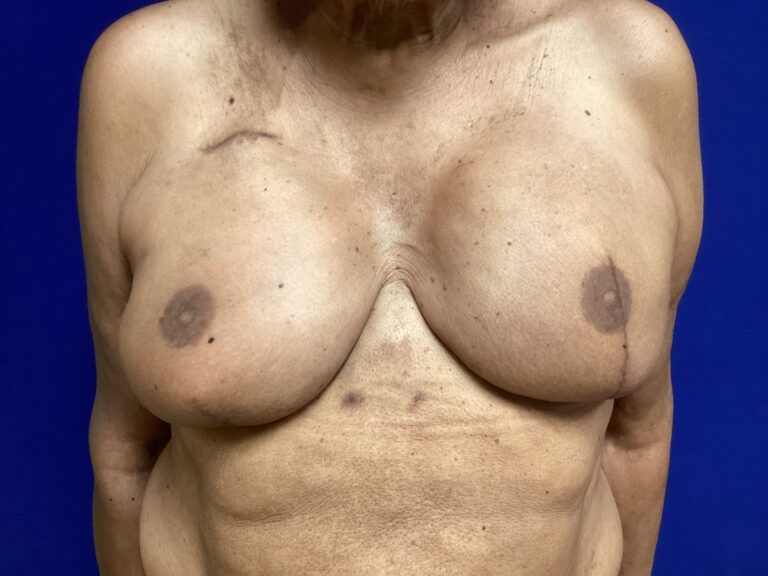 Nipple Tattooing Before & After