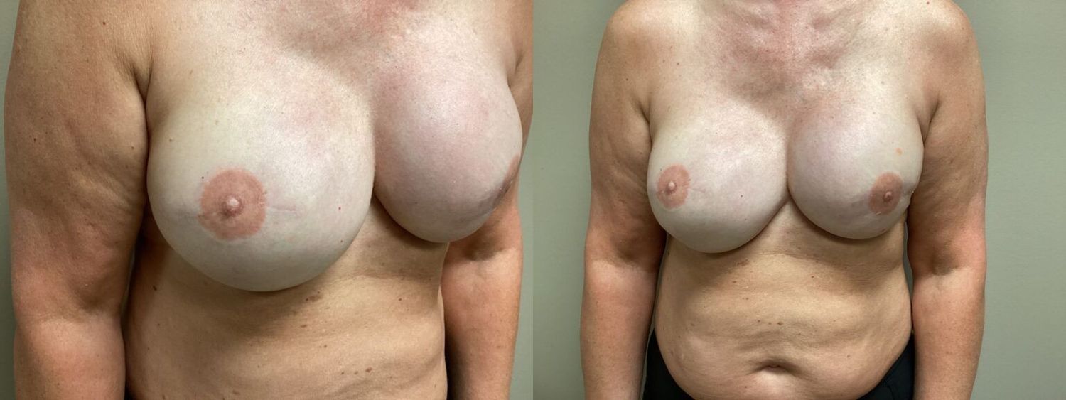 Nipple Tattooing Before & After